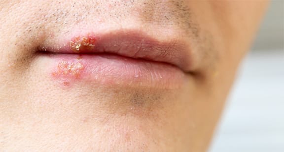 Cold Sores